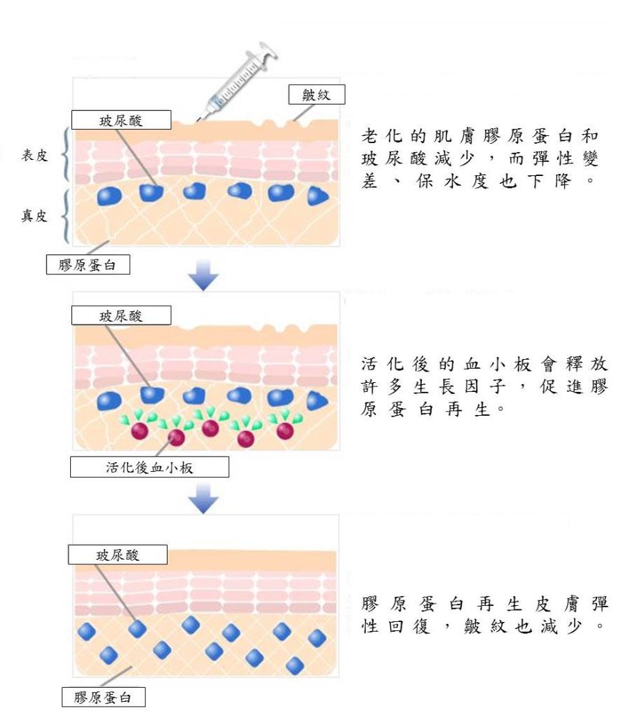 HAGFs-4